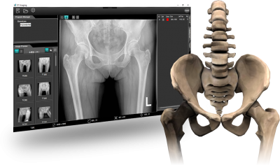 Osteoporosis AI Screening Assistant